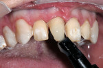 Figure 15  The luting material was applied directly to the tooth and the veneer placed on top. After clean-up and try-in, the remaining veneers were then placed in a similar manner.