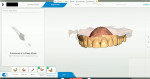 Fig 9. 3D intraoral scans were completed along with a hybrid scan of the mock-up to be used to copy in the CAD process.