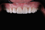 Fig 15. Final intraoral appearance with contrastor.