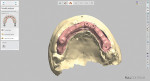 Fig 1. The bar scanned on the cast was blocked out with digital wax; note that four repositioning areas have not yet been cleared to allow for precise seating of the denture base onto the cast.
