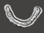 Fig 3. STL image of the intaglio of the denture base; four areas have not been relieved to allow precise seating of the metal substructure.
