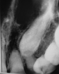 Figure 1  Radiograph demonstrating the impacted left maxillary canine.
