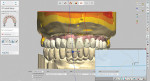 Fig 2. Denture set-up in the digital denture design software.