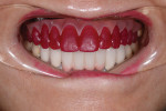 Fig 6. The teeth section printed in red burnout resin; note that adaptation to the pink denture base was inadequate, indicating an error.