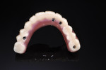 Fig 11. The zirconia teeth section bonded onto
metal and denture base, completing the prosthesis.
