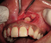 Figure 2  Figure 2 through Figure 4 Preoperative 1:3 smile for the patient in case one.