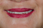 Fig 12. Extraoral smile view; note that teeth Nos. 8 and 9 were shorter after analog mechanical adjustment of the original design.