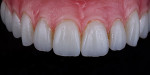 Fig 14. Gingiva-colored composite applied to the prosthesis in Fig 13 (Master Dental Technician: Phil Reddington).