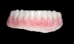 Fig 20. Pink composite was applied in a simplified manner, duplicating the computer-generated gingival contour, with soft-tissue–appropriate coloring.