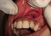 Figure 3  Figure 2 through Figure 4 Preoperative 1:3 smile for the patient in case one.