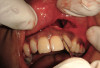 Figure 4  Figure 2 through Figure 4 Preoperative 1:3 smile for the patient in case one.