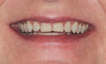 Fig 4. Initial orthodontic situation, showing patient’s relaxed smile with worn incisal edge display.
