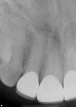 Fig 8. Final periapical
radiographs of the restorations prior to delivery. The marginal integrity interproximally was evaluated to
ensure adequate seating of restorations and closed margins.