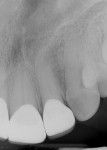 Fig 9. Final periapical
radiographs of the restorations prior to delivery. The marginal integrity interproximally was evaluated to
ensure adequate seating of restorations and closed margins.