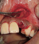 Figure 7  NovaBone being utilized for the bone graft over the facial defect.