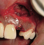 Figure 9  The implant was seated in the osteotomy demonstrating the apical aspect of the fixture visible in the defect.
