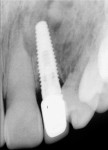 Figure 13  Radiograph of the restored implant showing healing of the grafted defect.