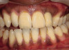 Figure 14  Final full-face photograph of case one. Proper vertical incisal edge position has been established.