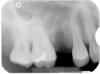 Figure 15  The preoperative full-face photograph of case two. The patient complained of a "gummy" smile.