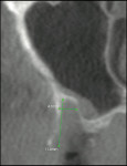 Figure 2  Three-dimensional CBCT scan with planning software.