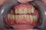 Preoperative retracted close-up photograph showing failed implant restorations and damage from parafunction.