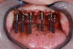 Impression copings were used to capture an implant-level open tray impression.