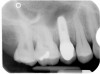 Figure 17  The 90¬∞ smile photograph of case two. The trajectory of the incisal edges is too far to the labial.