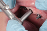 Finger pressure applied while torquing the multi-unit abutments into place.