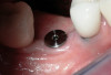 Figure 18  The rest position photograph of case two. Ideally, about 3.5 mm of incisor should be seen in this position.