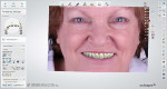 A 2D image of the patient with the try-in denture virtually in place used as a guide to verify the smile line, lip line, and buccal corridor as well as tooth shape.