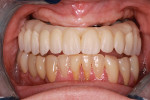 Try-in of milled PMMA temporary prosthetic to verify smile line, lip line, and occlusion.