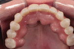 Retracted occlusal view of the fully seated  final full-arch implant retained prosthesis.