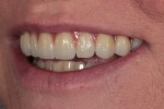 Postoperative left lateral view of the final prosthesis with teeth apart.