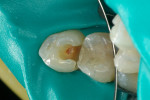 Isolated tooth No. 28 with carious material removed, resulting in pulpal exposure.