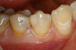 Preoperative close-up photograph of tooth No. 28.