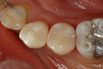 Immediate postoperative occlusal view of the restored teeth.