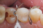 Completion of the restoration using 2-mm layers of a bioactive universal composite.