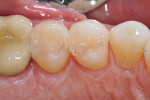 Postoperative occlusal view of the final restorations.