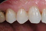 Postoperative buccal view of the final restorations.