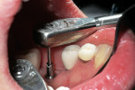 Figure 7  Implant stock titanium abutment placed and torqued (mirror image).