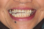 Preoperative exaggerated smile view with and without removable partial denture in place.