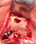 Buccal view of intrasinus implant positions with abutments in place.