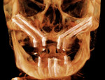 Postoperative CBCT scan demonstrating appropriate positioning of the zygomatic implants.