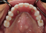 Occlusal view of the immediate maxillary prosthesis at 16 weeks postoperatively.