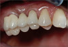 Figure 25  Note the poor emergence profile of the central incisors after the completed crown lengthening.