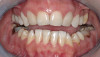 Figure 26  Note the three-plane reduction of the central incisors. This is critical to allow the incisal edges to be lingualized and still restore the teeth with natural facial contour.