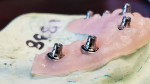 Fig 6. Hand tightened multi-unit abutments at all six locations on the model implant analogs.