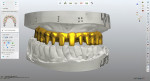 Fig 14. The framework design was based on the design of the approved denture to ensure optimal tissue and tooth display.