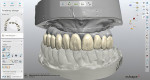 Fig 15. The crown design, which was selected from the laboratory’s library, followed the form and shape of the denture teeth from the pre-preparation model.
