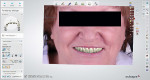 Fig 16. A 2D image of the patient with the try-in denture virtually in place used as a guide to verify the smile line, lip line, and buccal corridor as well as tooth shape.